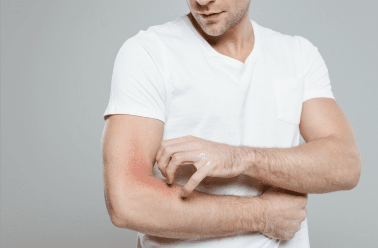 Most Effective Eczema Treatments